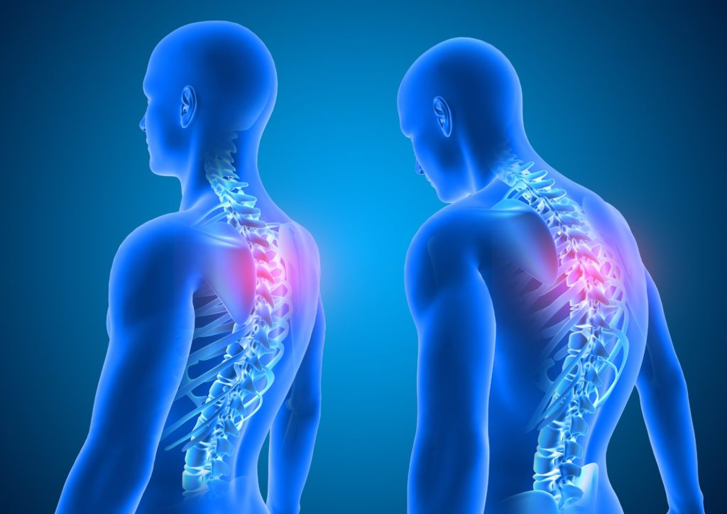 所沢　パーソナルジム　猫背